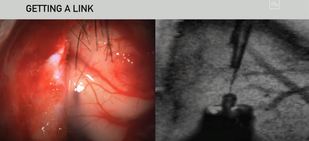 Inserting Neuralink brain chip electrodes in brain.