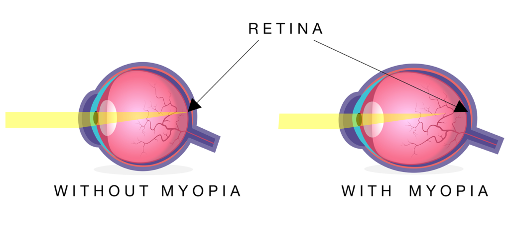 nearsightedness